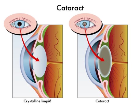 Cataract Surgery by OrangeCountySurgeons